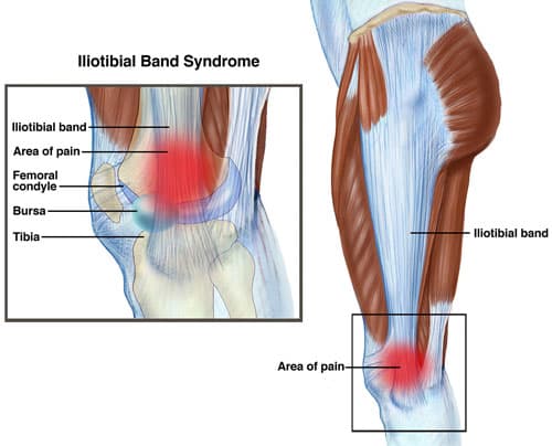 Anatomy diagram of iliotibial band syndrome showing the IT band running down the thigh to the lateral knee, with the area of pain at the femoral condyle and bursa labeled.