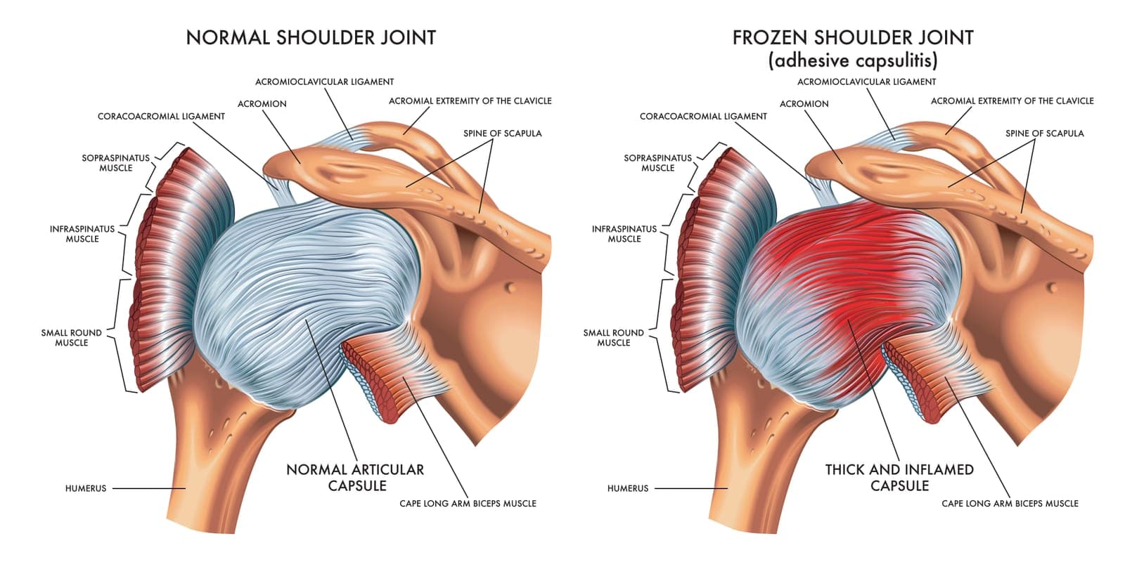 Side-by-side anatomy illustration comparing a normal shoulder joint with a roomy capsule to a frozen shoulder with a thickened, inflamed capsule.