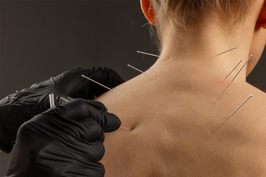 Close-up of a practitioner's gloved hands inserting acupuncture needles into a patient's upper back and shoulder.