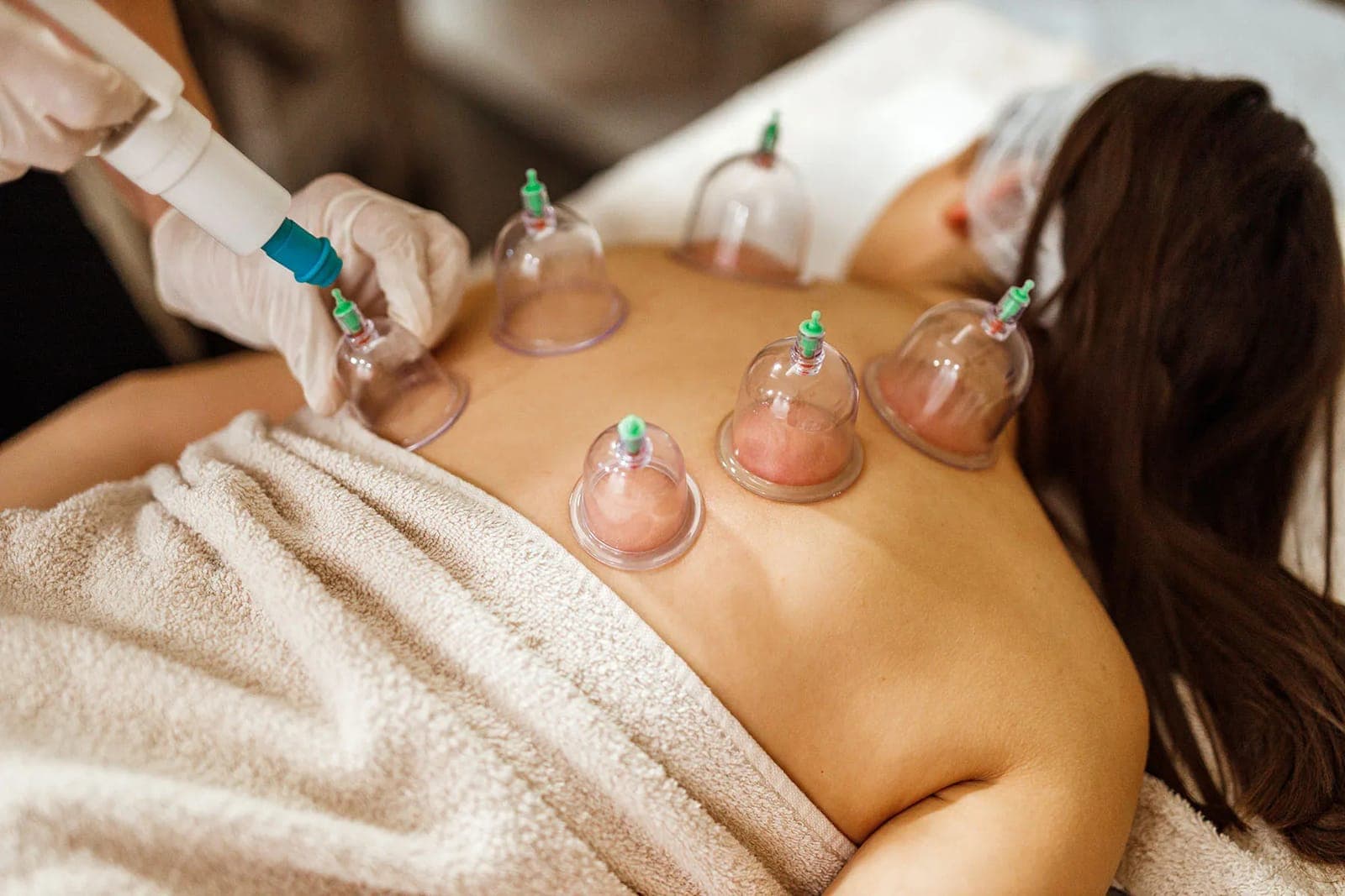 A therapist applying multiple suction cups to a patient's bare back during a cupping therapy session.