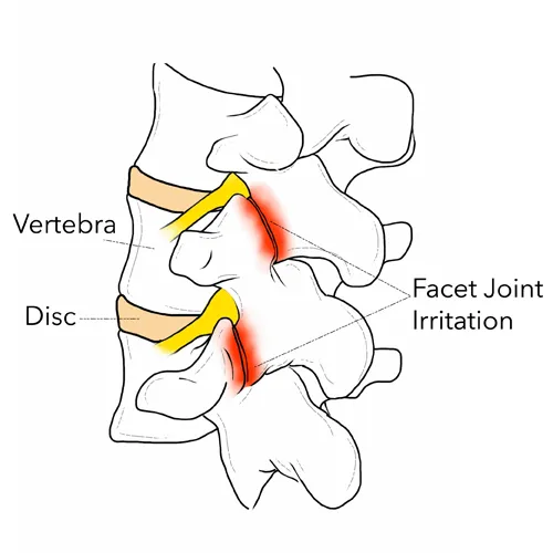 Side-view diagram of the lumbar spine showing vertebrae, discs, and a highlighted irritated facet joint between two vertebrae.