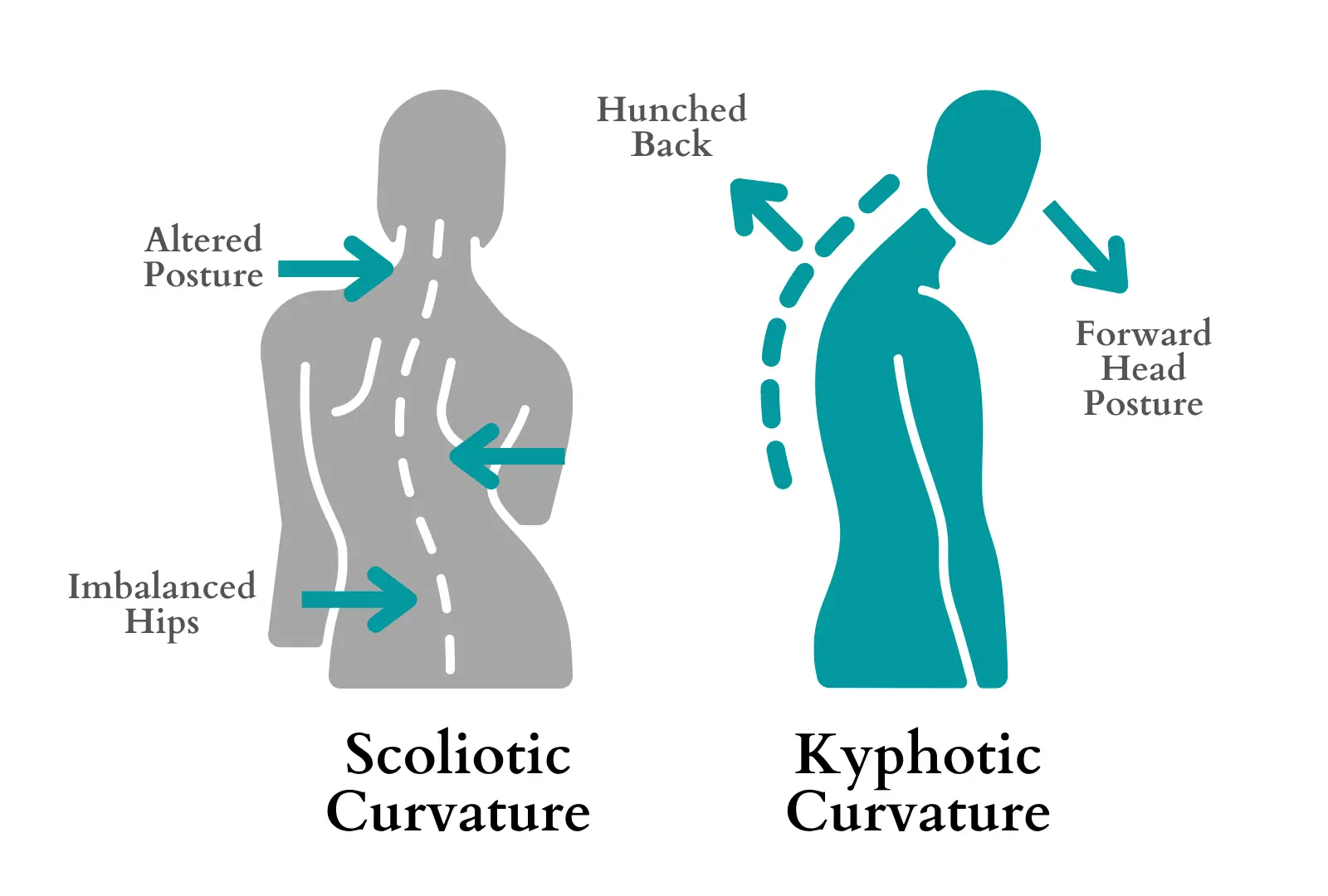 Diagram comparing scoliotic curvature (lateral S-curve with imbalanced hips) and kyphotic curvature (hunched back with forward head posture).