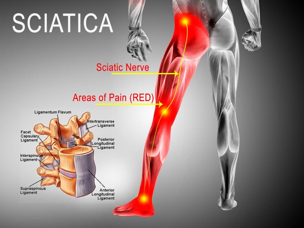 Medical illustration of the sciatic nerve path down the back and leg, highlighting common areas of sciatica pain.
