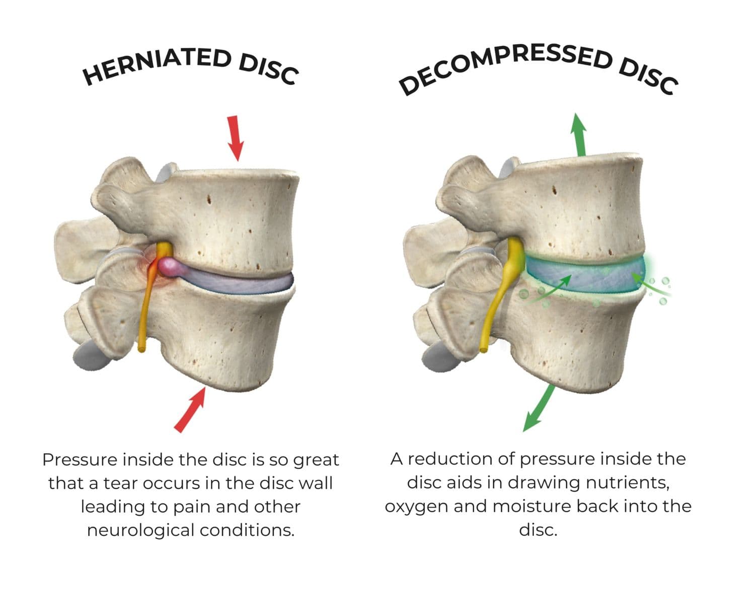 Side-by-side anatomy diagram comparing a herniated lumbar disc under pressure with a decompressed disc, where reduced pressure draws nutrients, oxygen and moisture back into the disc.