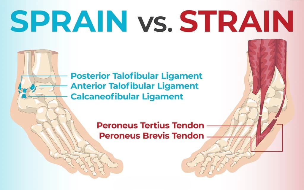 Anatomy diagram comparing an ankle sprain, with the talofibular and calcaneofibular ligaments labeled, to a strain of the peroneus tendons of the lower leg.